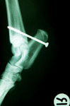 transarticular pin
